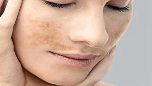 ملاسما چیست؟ بررسی علل، راه‌های پیشگیری و روش‌های درمان